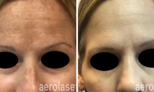 Aerolase Laser for hyerpigmentation | before and after photo | Meraki Wellness & Med Spa | Altamonte Springs, FL