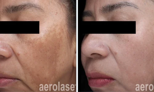 Hyperpigmentation skin treatment | before and after photo | Meraki Wellness & Med Spa | Altamonte Springs, FL