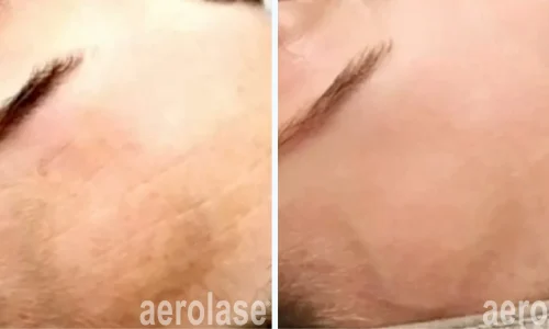 Hyperpigmentation on forehead | before and after photo | Meraki Wellness & Med Spa | Altamonte Springs, FL