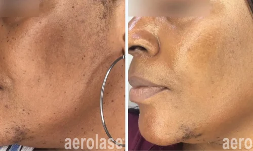 Pigmentation marks on face | before and after photo | Meraki Wellness & Med Spa | Altamonte Springs, FL