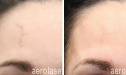 Hyperpigmentation reduction by Aerolase | before and after photo | Meraki Wellness & Med Spa | Altamonte Springs, FL