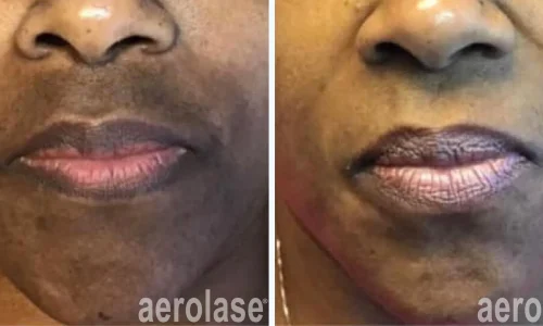 Hyperpigmentation around mouth | before and after photo | Meraki Wellness & Med Spa | Altamonte Springs, FL