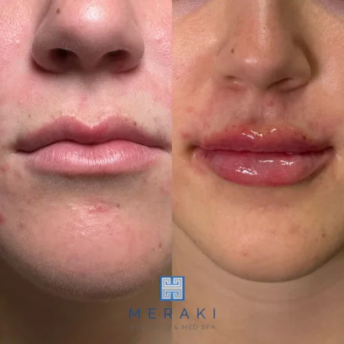 Women before and after Lip filler| Meraki Wellness & Med Spa | Altamonte Springs, FL