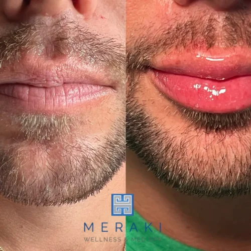 Men before and after Lip filler| Meraki Wellness & Med Spa | Altamonte Springs, FL