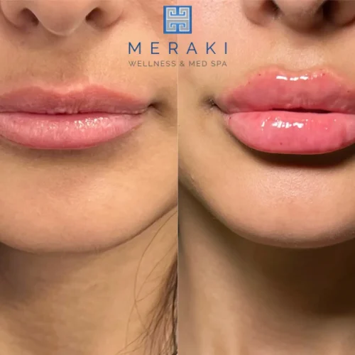 Women before and after Lip filler| Meraki Wellness & Med Spa | Altamonte Springs, FL