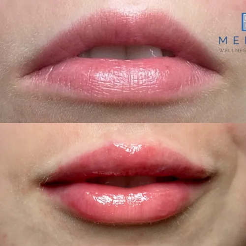 Women before and after Lip filler| Meraki Wellness & Med Spa | Altamonte Springs, FL