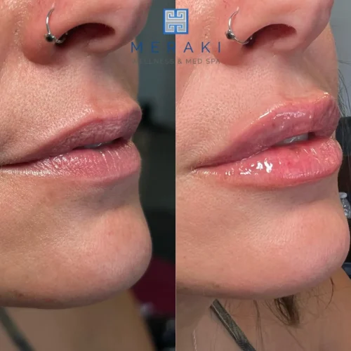 Women before and after Lip filler| Meraki Wellness & Med Spa | Altamonte Springs, FL