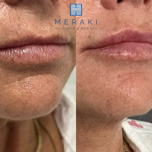 Women before and after Lip filler| Meraki Wellness & Med Spa | Altamonte Springs, FL