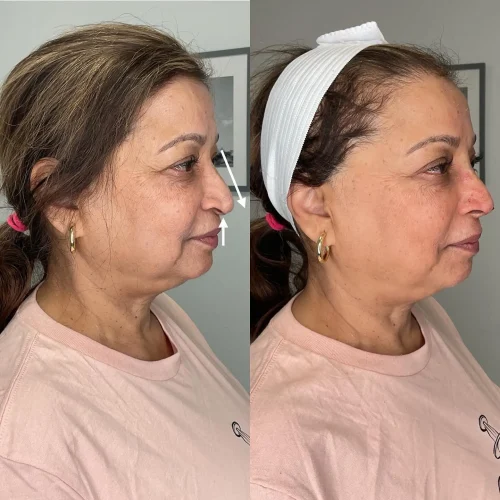 Women before and after non surgical treament | Meraki Wellness & Med Spa | Altamonte Springs, FL