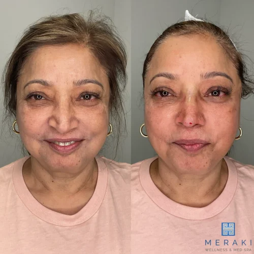 Women before and after non surgical treatment | Meraki Wellness & Med Spa | Altamonte Springs, FL