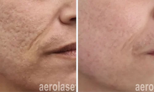 Scars on face | | before and after photo | Meraki Wellness & Med Spa | Altamonte Springs, FL