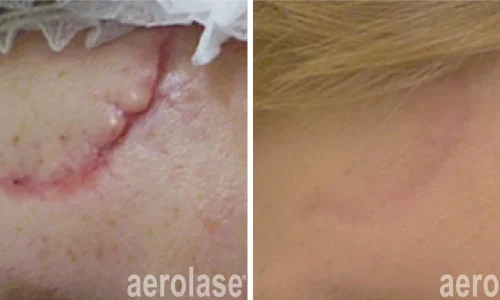 Surgical scars removal | before and after photo | Meraki Wellness & Med Spa | Altamonte Springs, FL