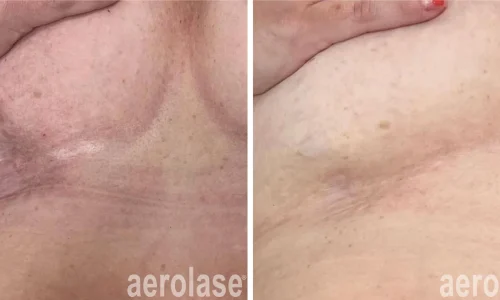 Scars treatment | before and after photo | Meraki Wellness & Med Spa | Altamonte Springs, FL