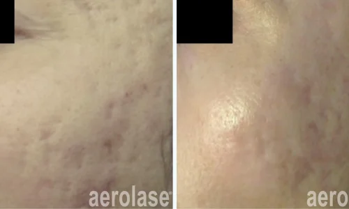 Scars treatment by Aerolase laser | before and after photo | Meraki Wellness & Med Spa | Altamonte Springs, FL