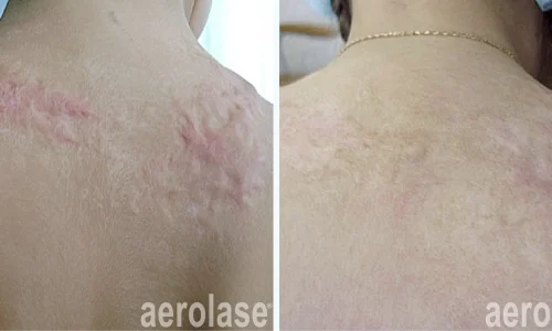 Scra removal from back | before and after photo | Meraki Wellness & Med Spa | Altamonte Springs, FL