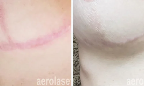 Scar under chin | Aerolase Laser | before and after photo | Meraki Wellness & Med Spa | Altamonte Springs, FL