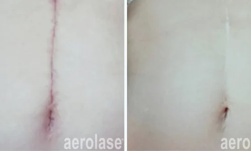 Scar on stomach | Aerolase Laser | before and after photo | Meraki Wellness & Med Spa | Altamonte Springs, FL