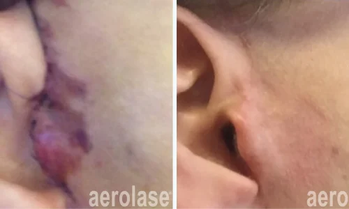 Scar treatment by Aerolase Laser | before and after photo | Meraki Wellness & Med Spa | Altamonte Springs, FL