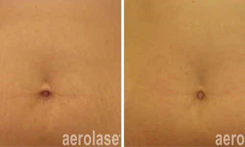 Naval scar treatment | before and after photo | Meraki Wellness & Med Spa | Altamonte Springs, FL