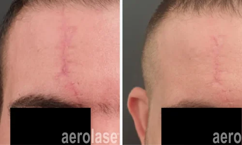 Surgical scar treatment | before and after photo | Meraki Wellness & Med Spa | Altamonte Springs, FL