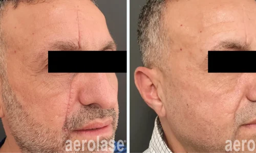 Surgical scar removal from face | before and after photo | Meraki Wellness & Med Spa | Altamonte Springs, FL