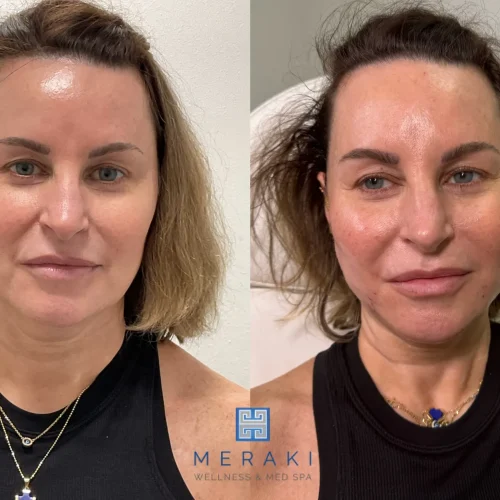 Women before and after Silhouette-Threads treament | Meraki Wellness & Med Spa | Altamonte Springs, FL