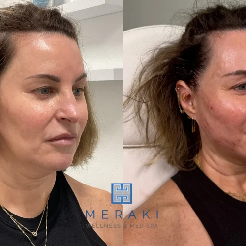 Silhouette Threads | before and after photo | Meraki Wellness & Med Spa | Altamonte Springs, FL