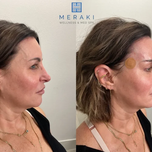 Women before and after Silhouette-Threads treament | Meraki Wellness & Med Spa | Altamonte Springs, FL