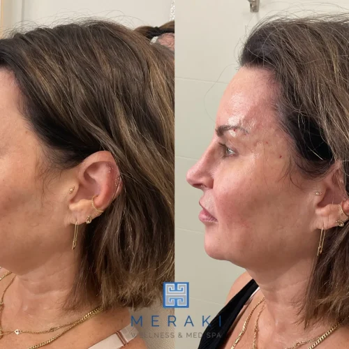 Women before and after Silhouette-Threads treament | Meraki Wellness & Med Spa | Altamonte Springs, FL