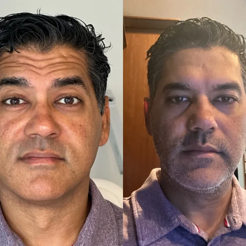 Men before and after | Meraki Wellness & Med Spa | Altamonte Springs, FL