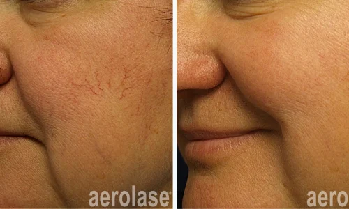 Veins on face removal | before and after photo | Meraki Wellness & Med Spa | Altamonte Springs, FL