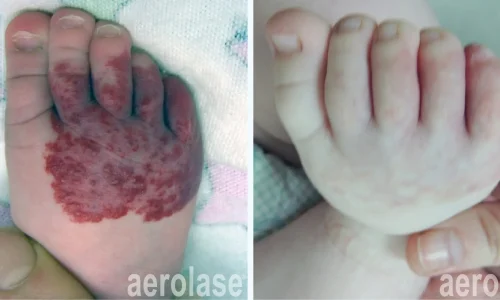 Veins cluster on baby's foot | Aerolase laser | before and after photo | Meraki Wellness & Med Spa | Altamonte Springs, FL