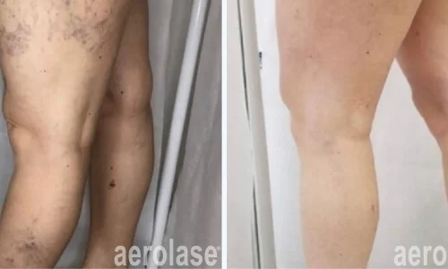 Varicose veins on legs | before and after photo | Meraki Wellness & Med Spa | Altamonte Springs, FL