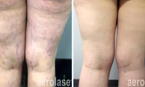 Spider veins on legs | | before and after photo | Meraki Wellness & Med Spa | Altamonte Springs, FL