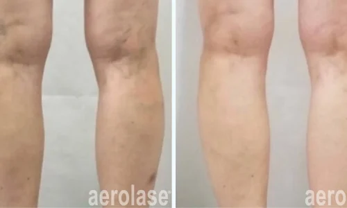 Spider veins treatment | before and after photo | Meraki Wellness & Med Spa | Altamonte Springs, FL