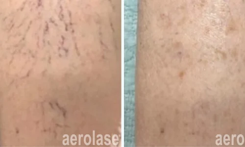 Veins removal by Aerolase | before and after photo | Meraki Wellness & Med Spa | Altamonte Springs, FL