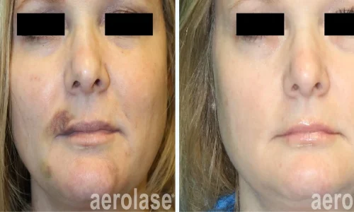 Aerolase treatment | before and after photo | Meraki Wellness & Med Spa | Altamonte Springs, FL