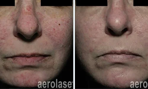 Veins on face in red color | before and after photo | Meraki Wellness & Med Spa | Altamonte Springs, FL