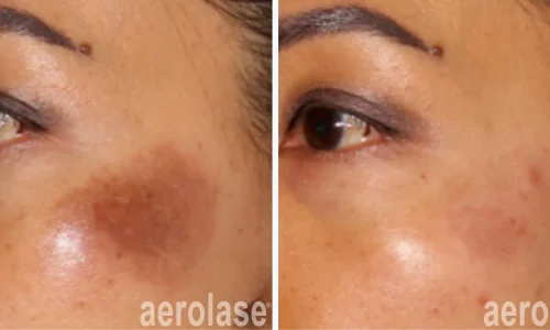 Veins removal by Aerolase laser | before and after photo | Meraki Wellness & Med Spa | Altamonte Springs, FL