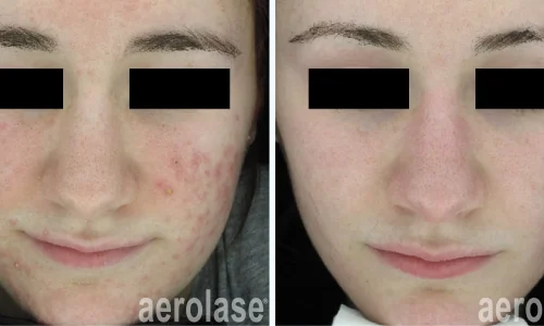 Acne treatment for face | before and after photo | Meraki Wellness & Med Spa | Altamonte Springs, FL