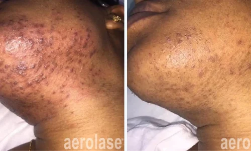 a close up of acne on chin | before and after photo | Meraki Wellness & Med Spa | Altamonte Springs, FL