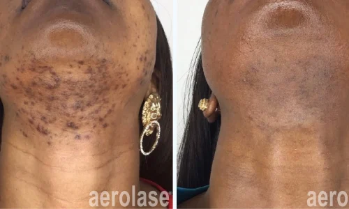 acne under chin and neck area | before and after photo | Meraki Wellness & Med Spa | Altamonte Springs, FL