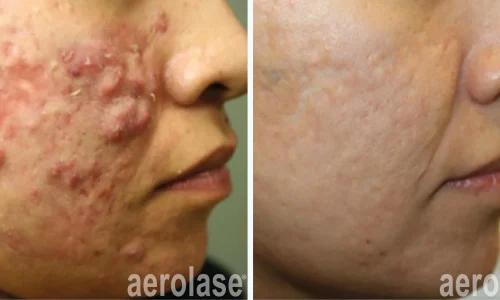 Cystic acne | before and after photo | Meraki Wellness & Med Spa | Altamonte Springs, FL