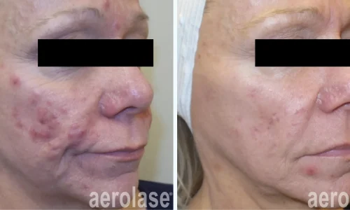 Acne treatment on face | before and after photo | Meraki Wellness & Med Spa | Altamonte Springs, FL