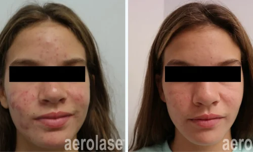 Acne all over face | before and after photo | Meraki Wellness & Med Spa | Altamonte Springs, FL