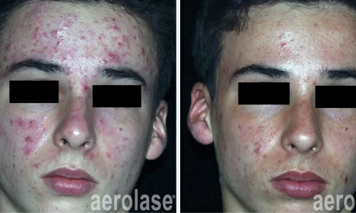 a boy with acne on his face | before and after photo | Meraki Wellness & Med Spa | Altamonte Springs, FL