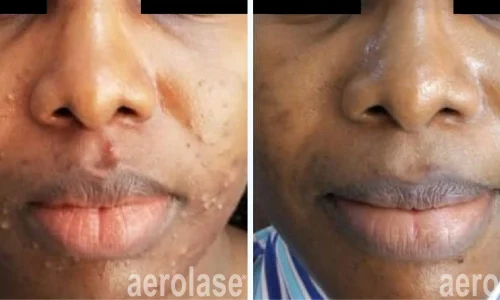 a close-up of a person's acne | before and after photo | Meraki Wellness & Med Spa | Altamonte Springs, FL