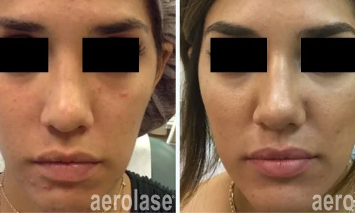 a woman with acne on her face | before and after photo | Meraki Wellness & Med Spa | Altamonte Springs, FL