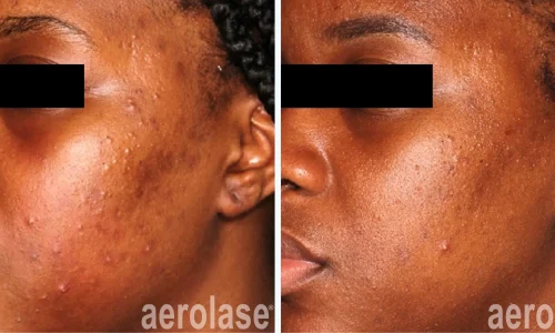 a close-up of a woman's acne | before and after photo | Meraki Wellness & Med Spa | Altamonte Springs, FL