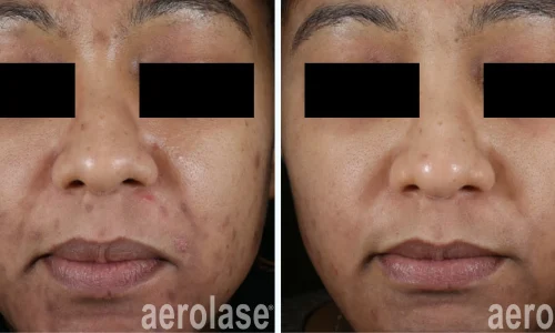 a close up of a woman's acne face |before and after photo | Meraki Wellness & Med Spa | Altamonte Springs, FL